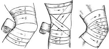 Черепашья повязка на коленный сустав