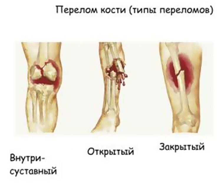 Перелом пятка кость без смещения картинка