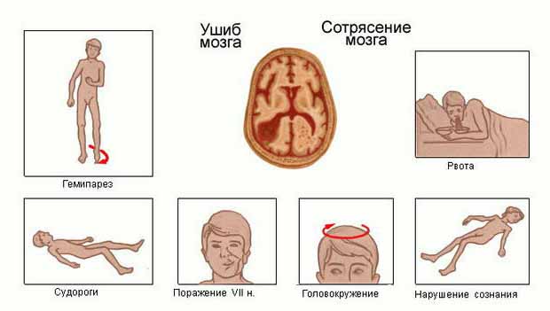 Ушиб и сотрясение головного мозга