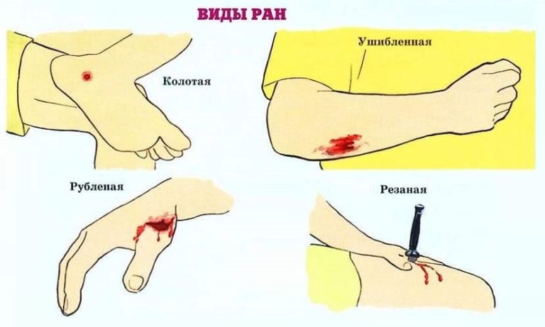 Виды ран картинки